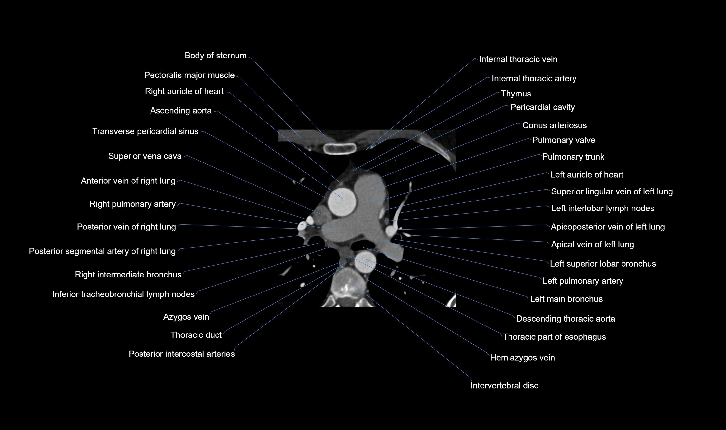 CT heart (coronary angiogram) axial view cross sectional anatomy labelled radiology image-00014.webp